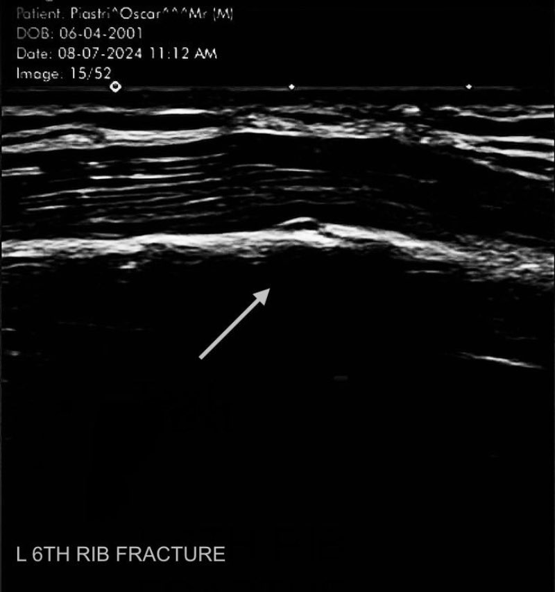 gebroken Rib Oscar Piastri