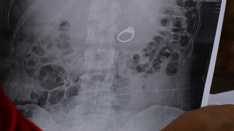 Rontgen foto van ring in buik
