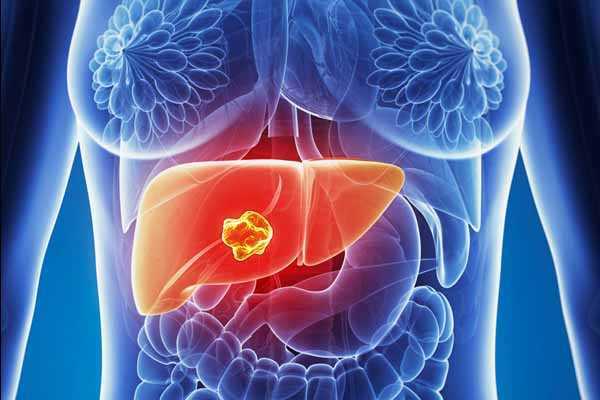 relación entre abuso de alcohol y cáncer.