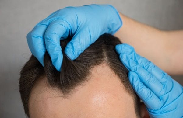 mejor tecnica injerto capilar