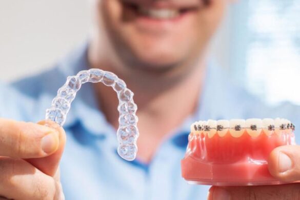 comparativa invisalign o brackets