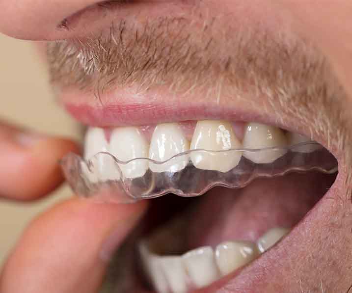 invisalign ventajas