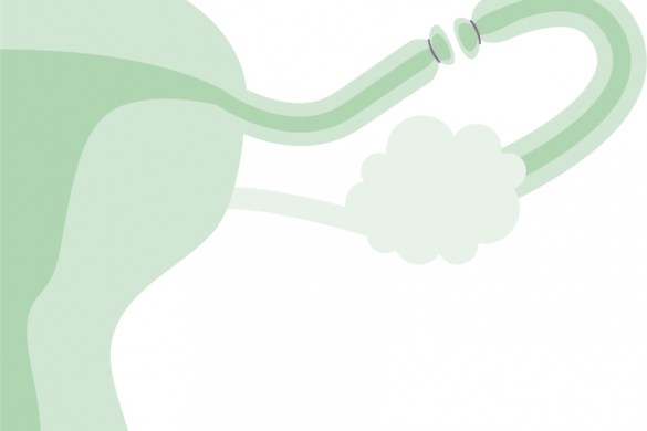 mejores alternativas vasectomia