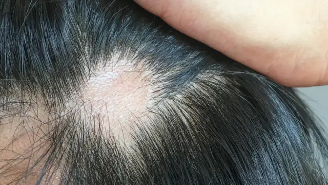 caida de pelo por estrés