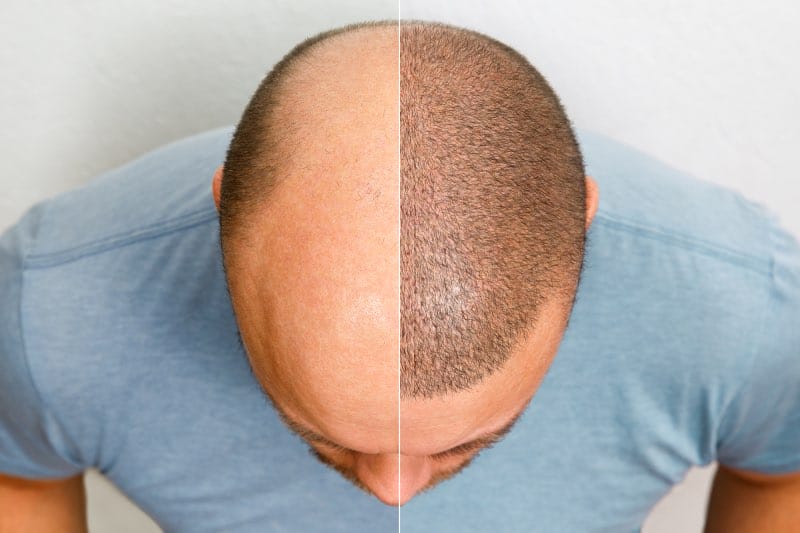 Man voor en na haar transplantatie na haarverlies 